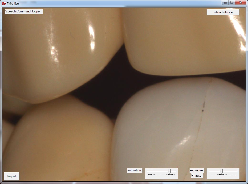 Loupe