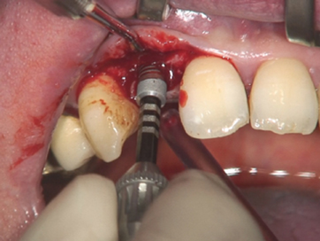 placing an implant regio 12